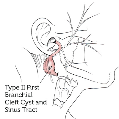 Type-II-First-Branchial-Cleft-Cyst-Sinus-Tract