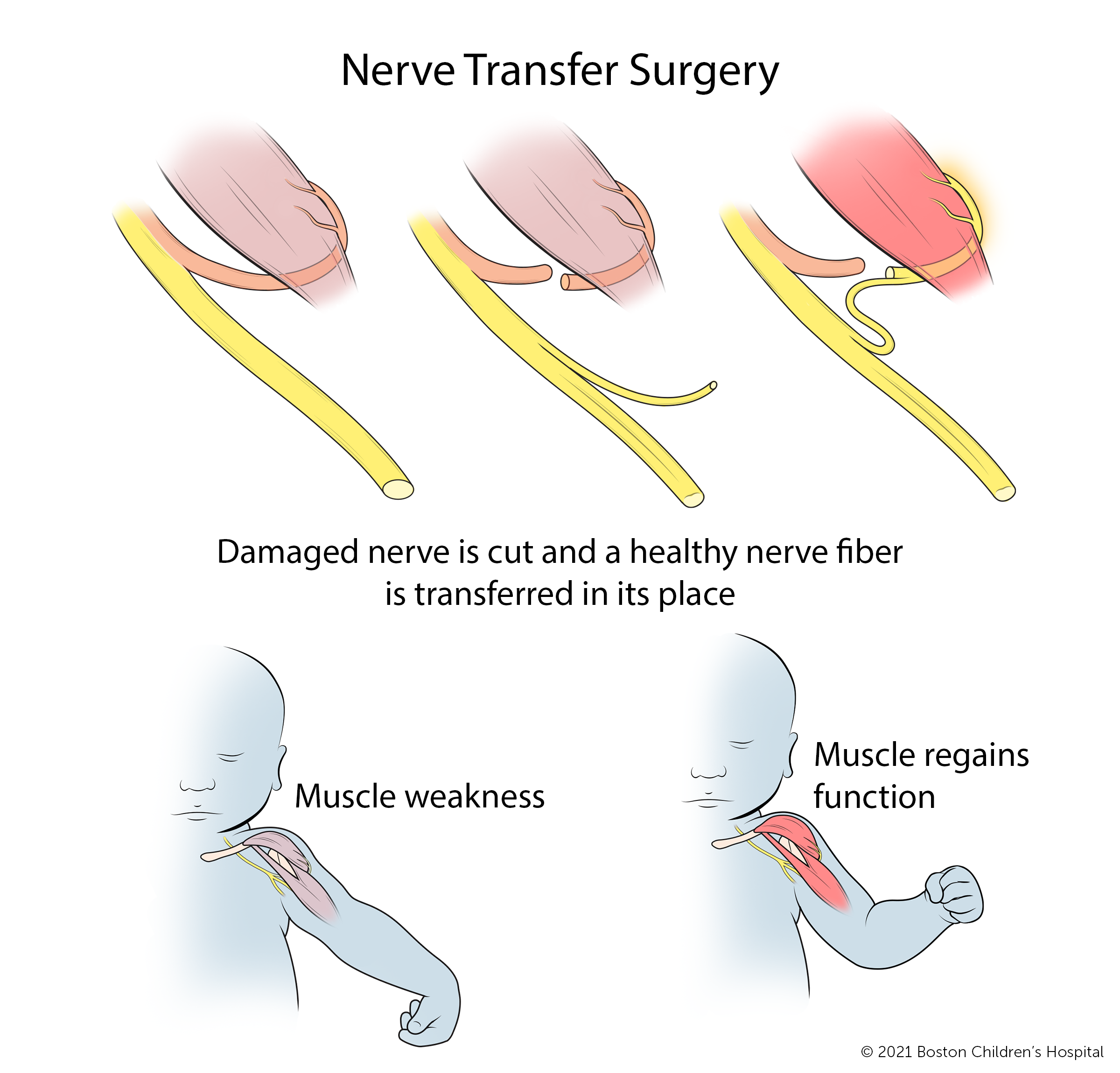 During nerve transfer surgery, the damaged nerve is cut and a healthy nerve fiber is transferred into its place. Over time, the area of muscle weakness regains function.