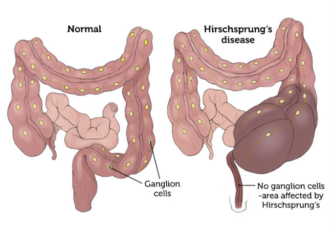 Hirschsprung's Disease comparison