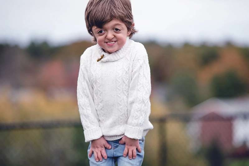 Joao, a boy with Apert syndrome, wears jeans and a sweater as he poses for a photograph.