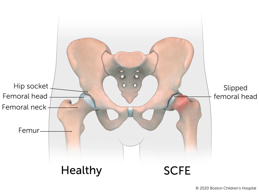 A weakness of the growth plate in the thigh bone’s upper end causes the "ball" of the bone to slip off the neck of the bone.