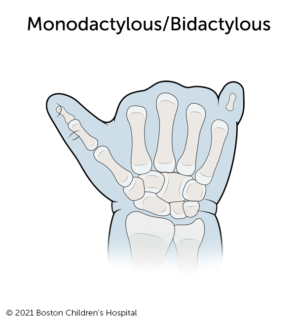 Illustration of monodactylous/bidactylous symbrachydactyly.