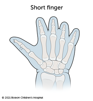 Illustration of short finger symbrachydactyly