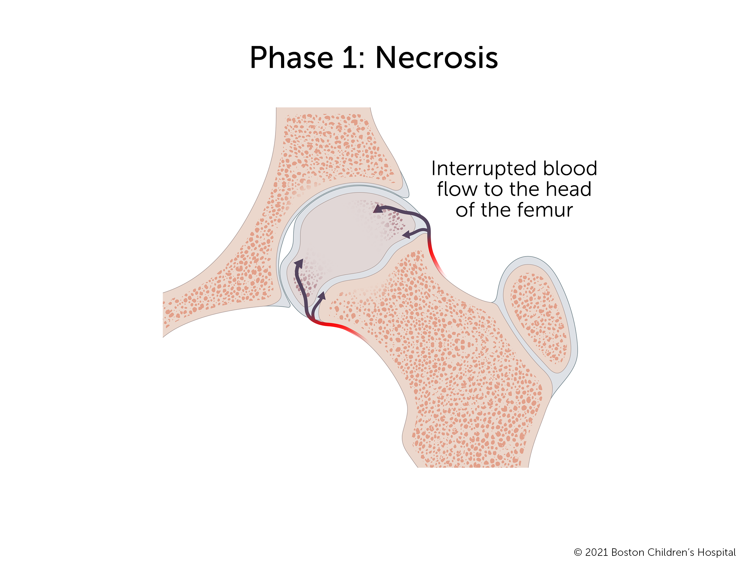 Phase 1: Necrosis. Interrupted blood flow to the head of the femur causes the femoral head to become misshapen and a pocket to open up in the hip socket.