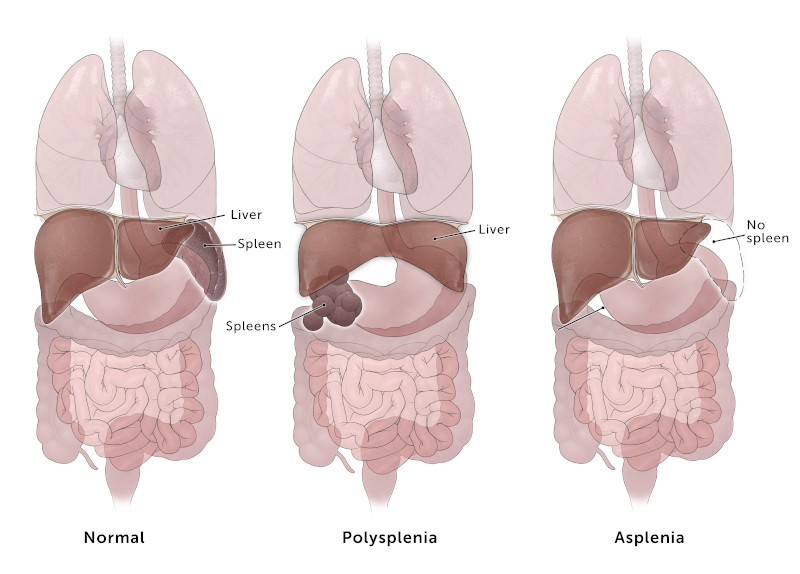 Illustration of how spleen can be affected by heterotaxy