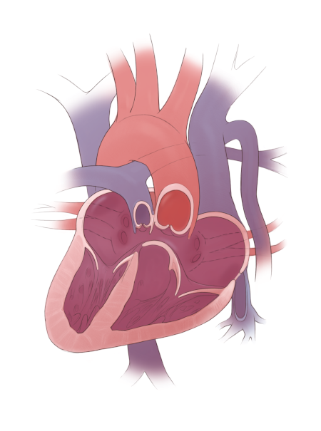 Image of heterotaxy heart