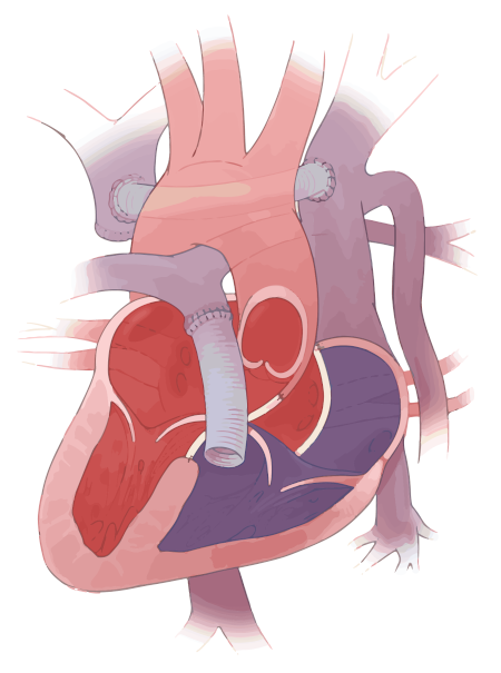 Image of heart after complex biventricular repair