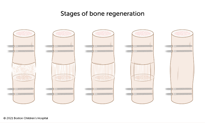 New bone grows in the gap that has been created by limb lengthening.