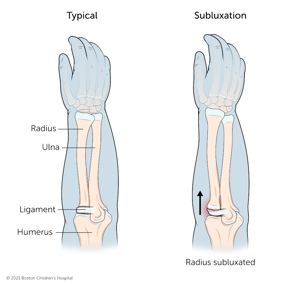 A nursemaid’s elbow in which the radius has become partially separated from the elbow.
