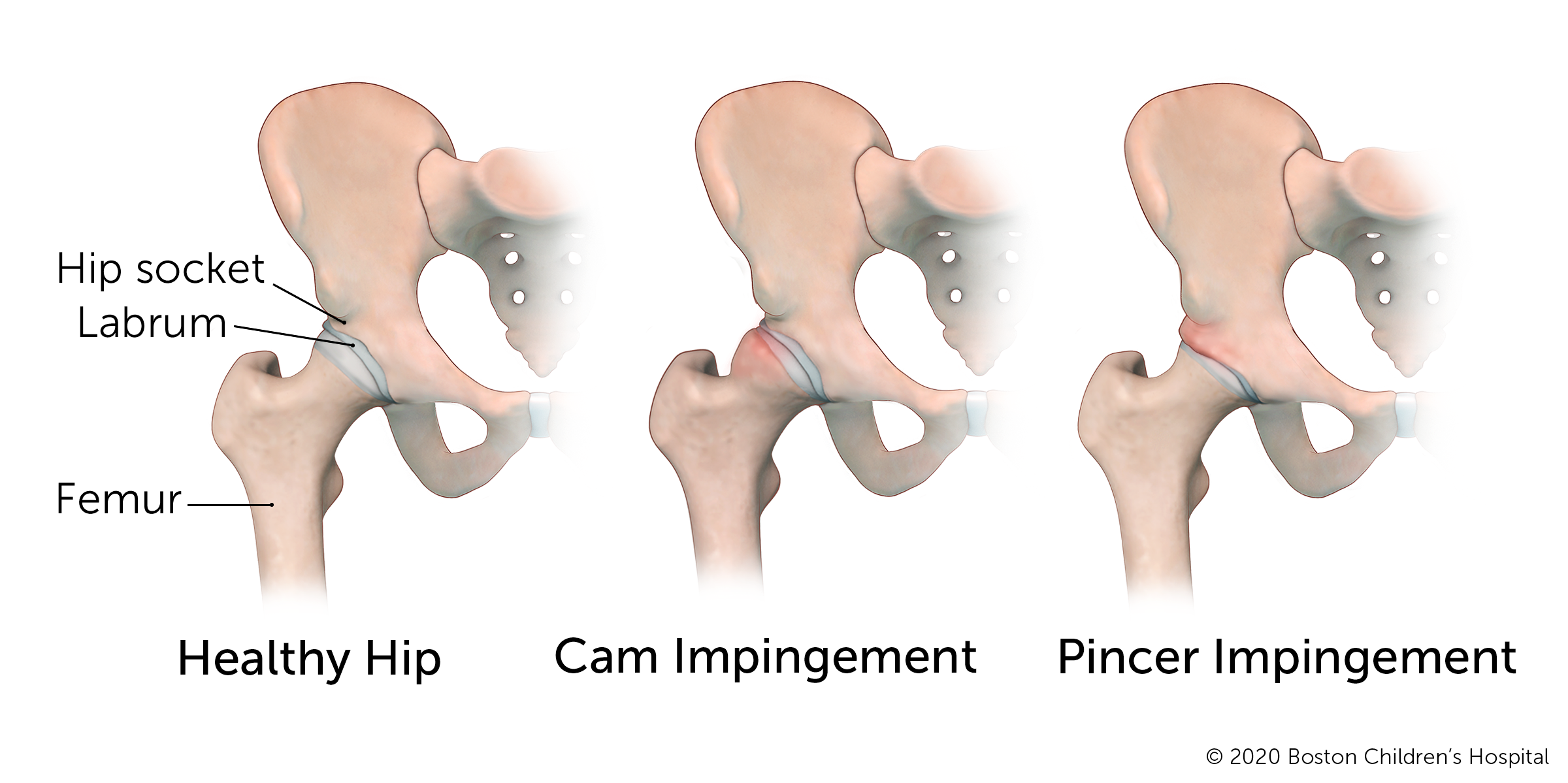 Hip impingement: Here is a look at a healthy hip, a hip with a cam impingement, and a hip with a pincer impingement.