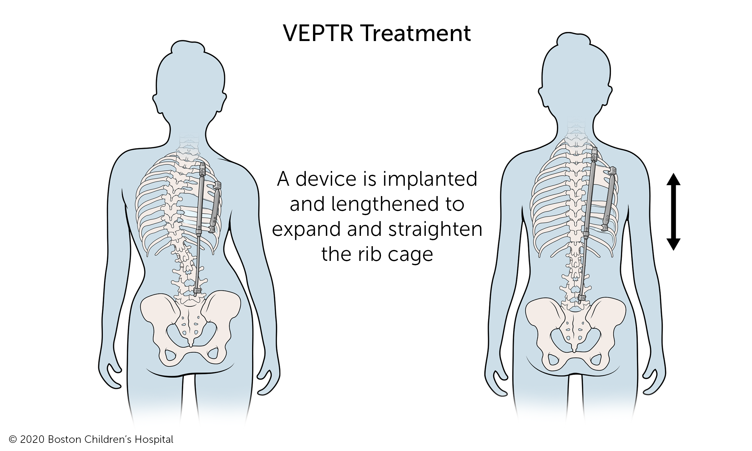 VEPTR™ treatment: A device is implanted and lengthened to expand and straighten the rib cage.