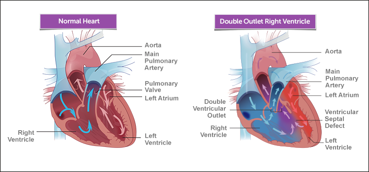 Normal heart and DORV heart illustration 