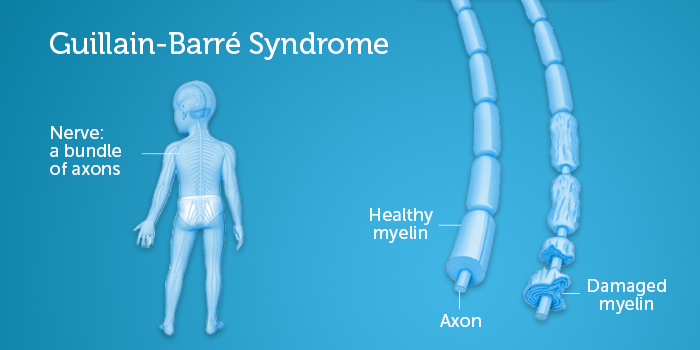 Guillain-Barre Syndrome: healthy myelin and damaged myelin. 