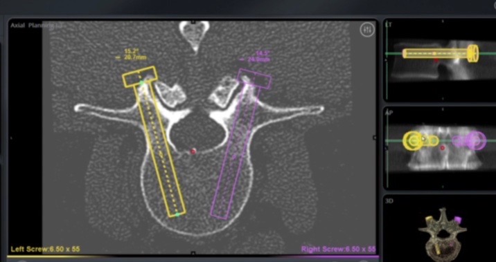 Additional pre- or intra-operative planning view option allowing visualization of the computed topography (CT) anatomy and planned pedicle screw trajectory