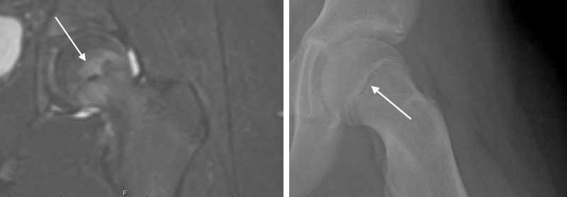 Figure 2: MRI (left) showing peritubercle edema suggestive of SCFE compared to a radiographic image of the same hip with peritubercle lucency