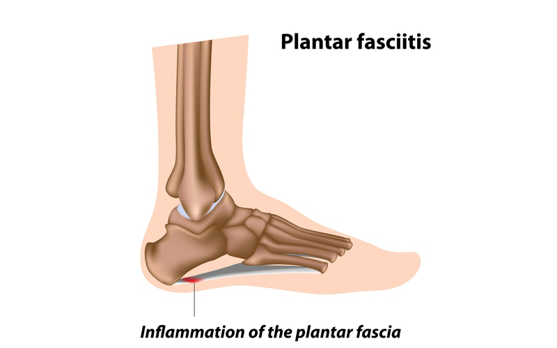 Plantar fasciitis is pain on the bottom of one or both heels, caused by irritation to the plantar fascia, which are the dense tissue bands that connect the heels to the toes.