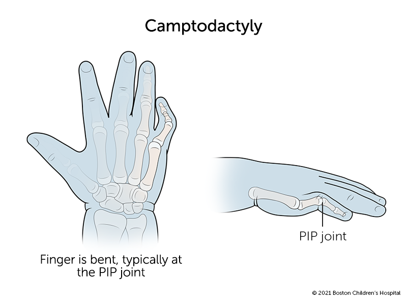 A pinkie finger with camptodactyly that bends abnormally at the proximal interphalangeal PIP joint.