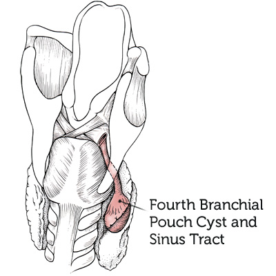 Fourth-Branchial-Pouch-Cyst-and-Sinus-Tract