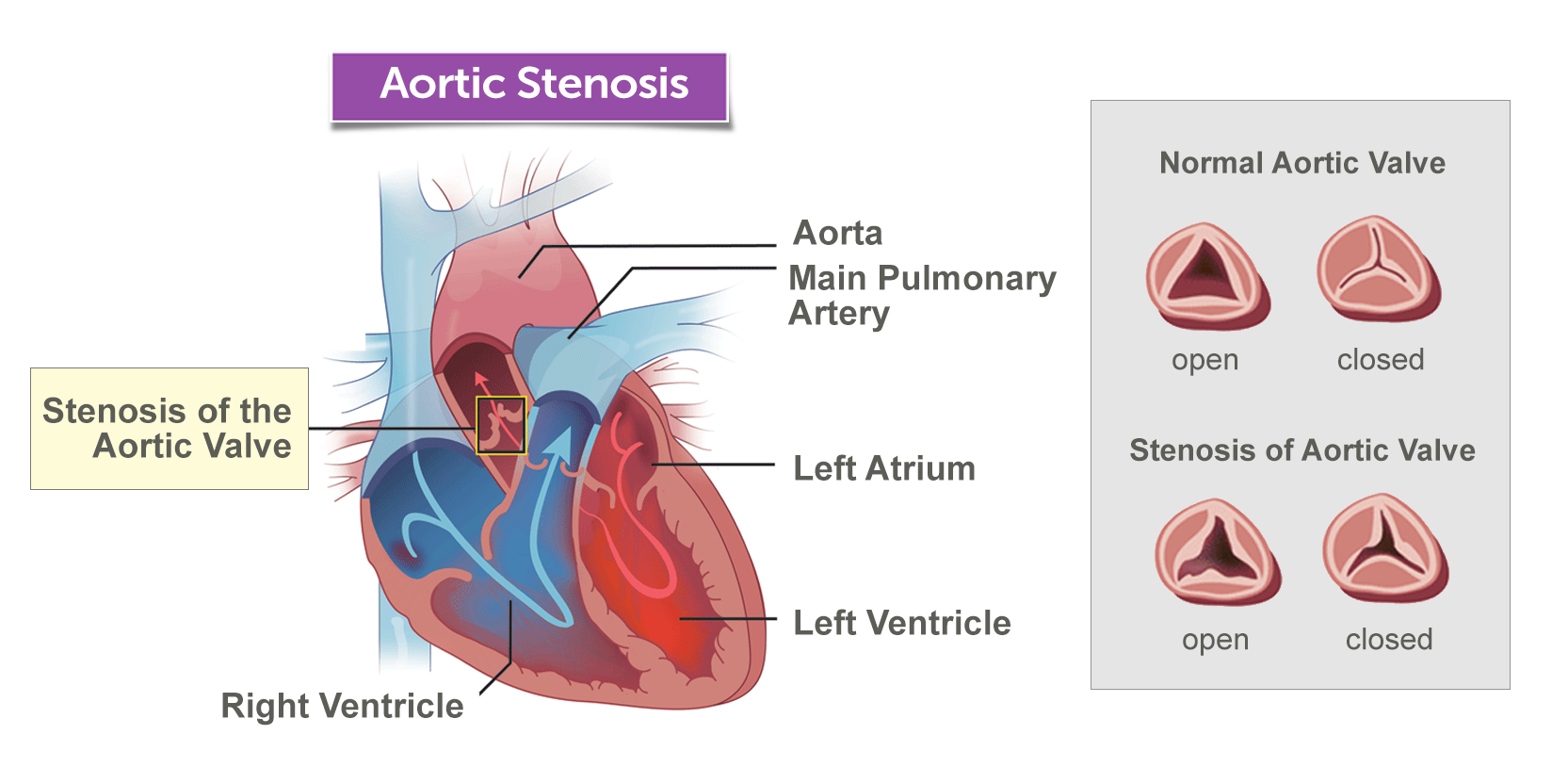 “aortic
