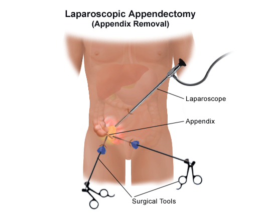 A laparoscopic appendectomy for a patient with appendicitis.