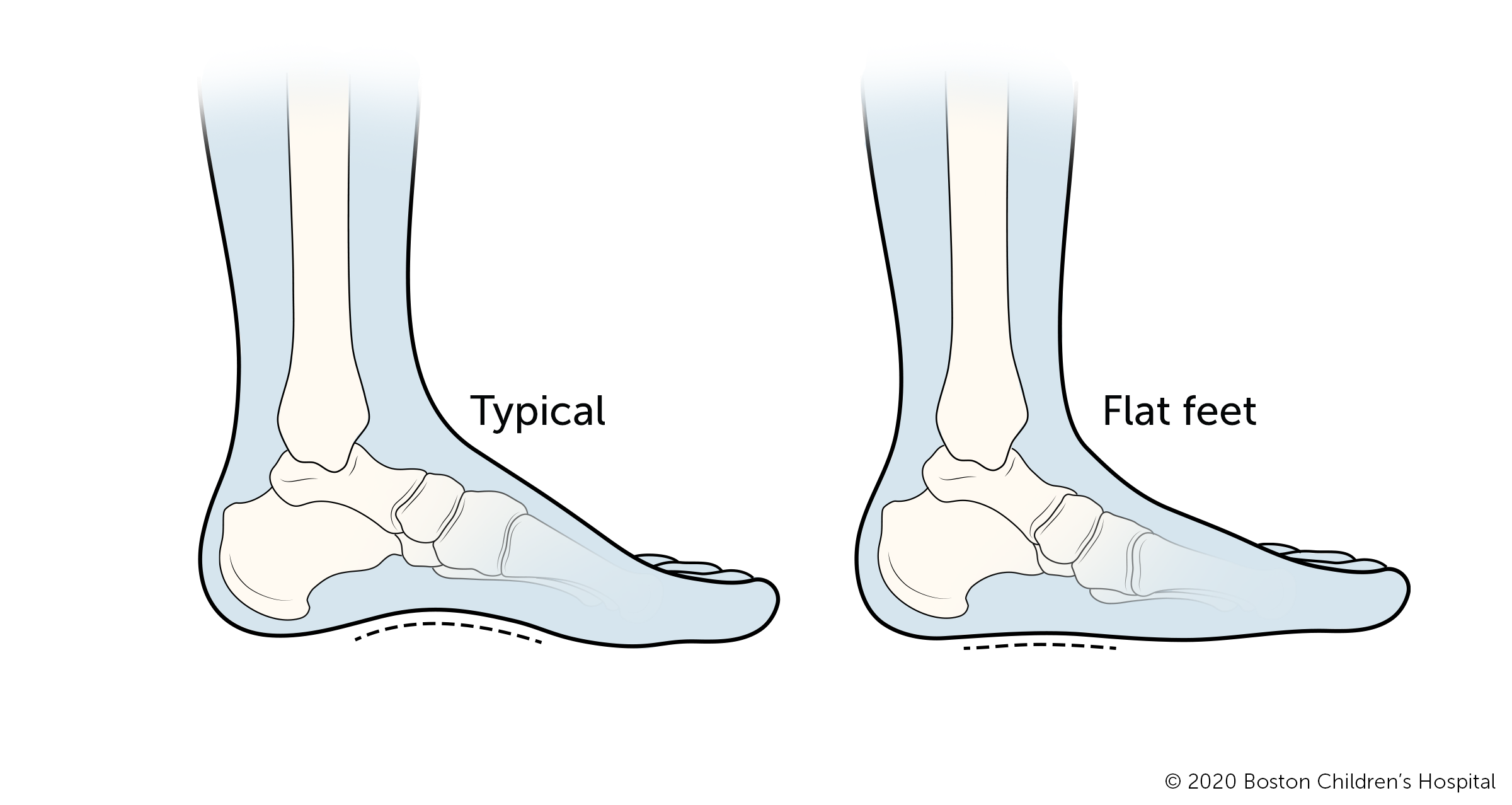 This is an illustration of a normal foot and a flatfoot.