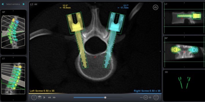 Screen shot of intraoperative planning software, setting the starting point, trajectory, and size of pedicle screws