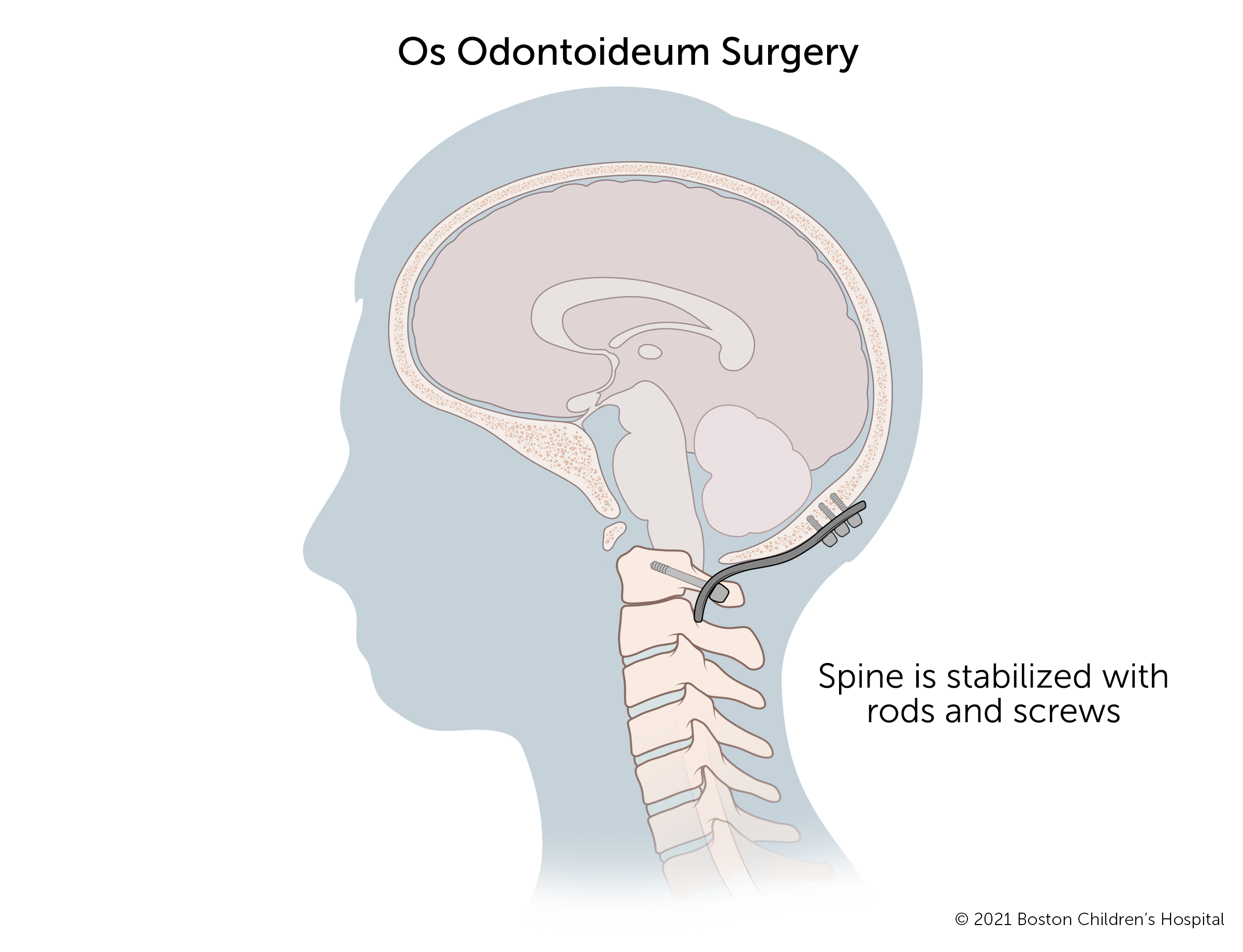 Os odontoid surgery involves aligning the vertebrae in the cervical spine and decompressing the spinal cord. The spine is then stabilized with rods and screws.