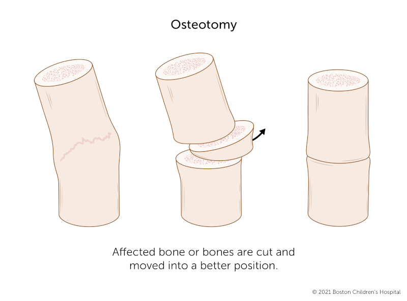 During an osteotomy to repair a malunion, the bone is cut and repositioned in a straighter position.