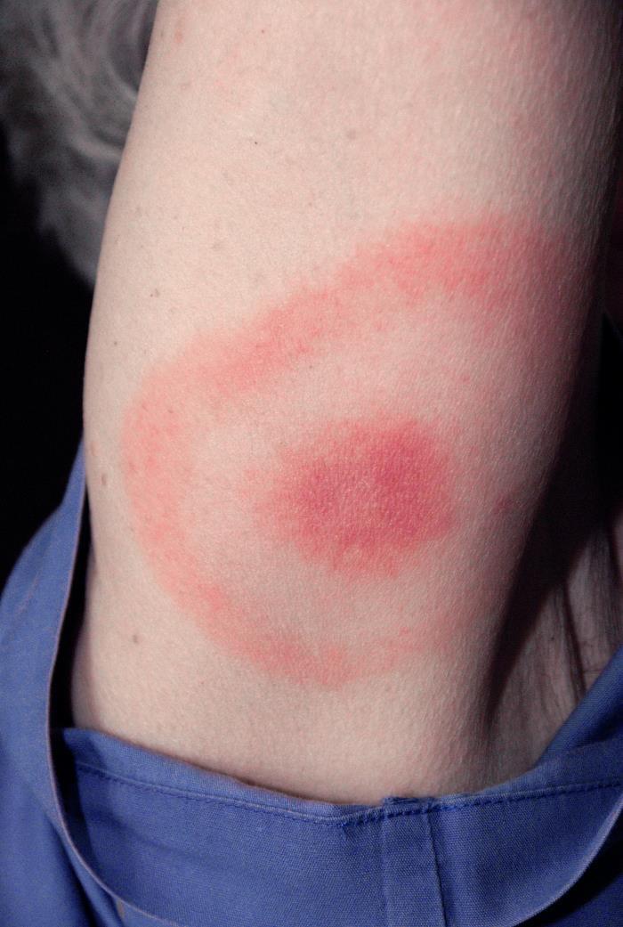 A bulls-eye-like rash is one of the symptoms of a tick bite. (Credit: CDC/James Gathany)