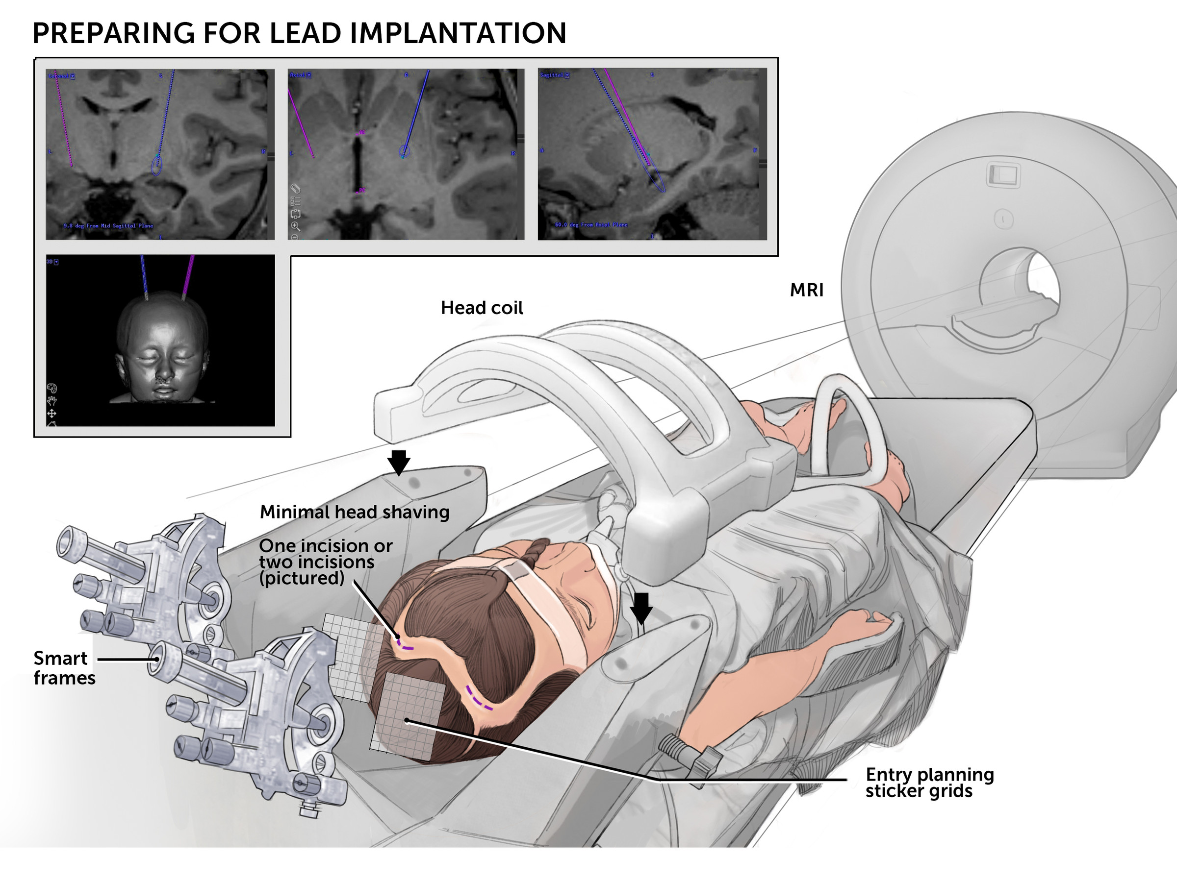 Deep Brain Stimulation Preparing for Lead Implantation