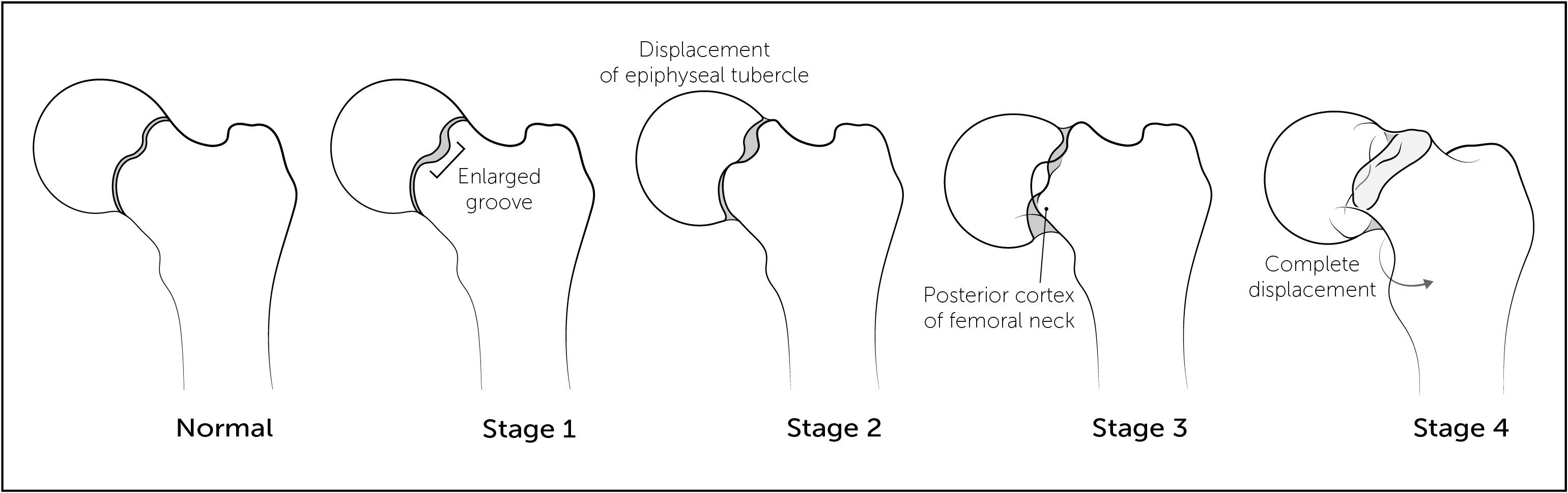 Proposed new SCFE classification based on the relationship of the tubercle and its metaphyseal socket.