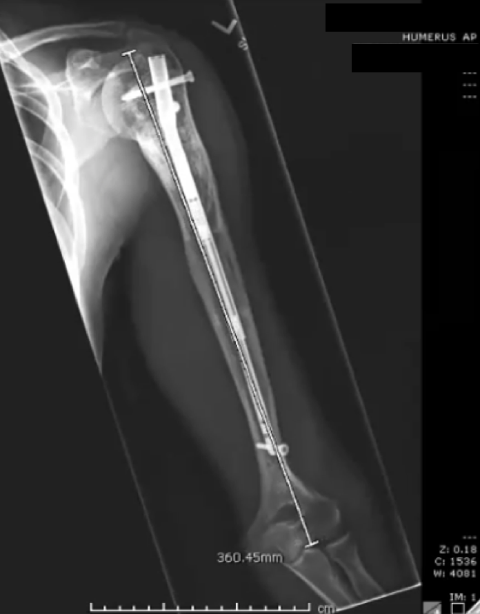 An image taken in January 2021 shows where regenerate bone consolidated in the humerus. 