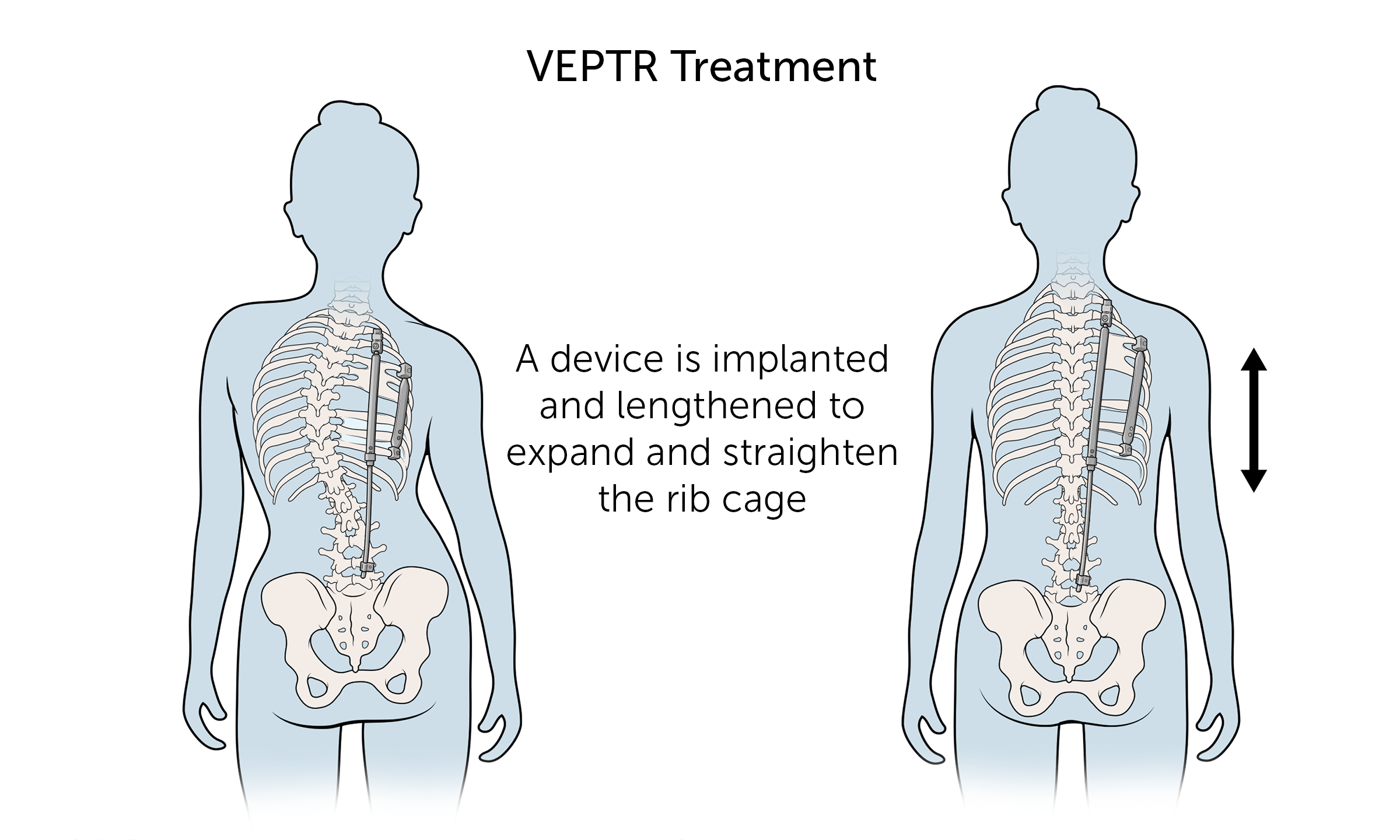 In VEPTR treatment, a device is implanted and lengthened to expand and straighten the rib cage.
