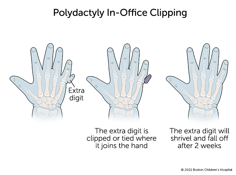 A hand with polydactyly that has a mini extra pinkie. During in-office clipping, the extra finger is clipped or tied where it joins the hand. The extra digit will shrivel and fall off after two weeks.