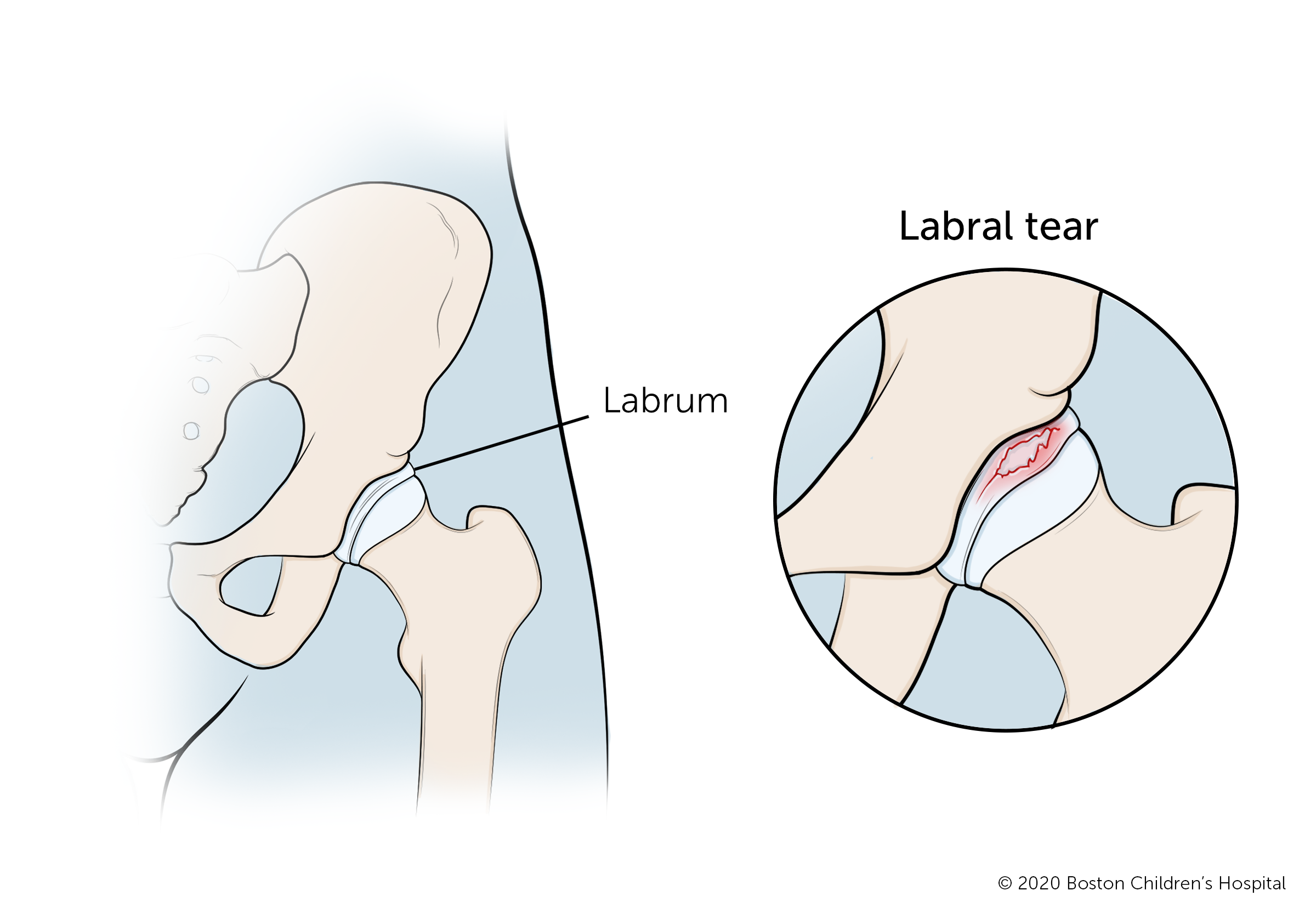 This is a look at a hip labral tear.