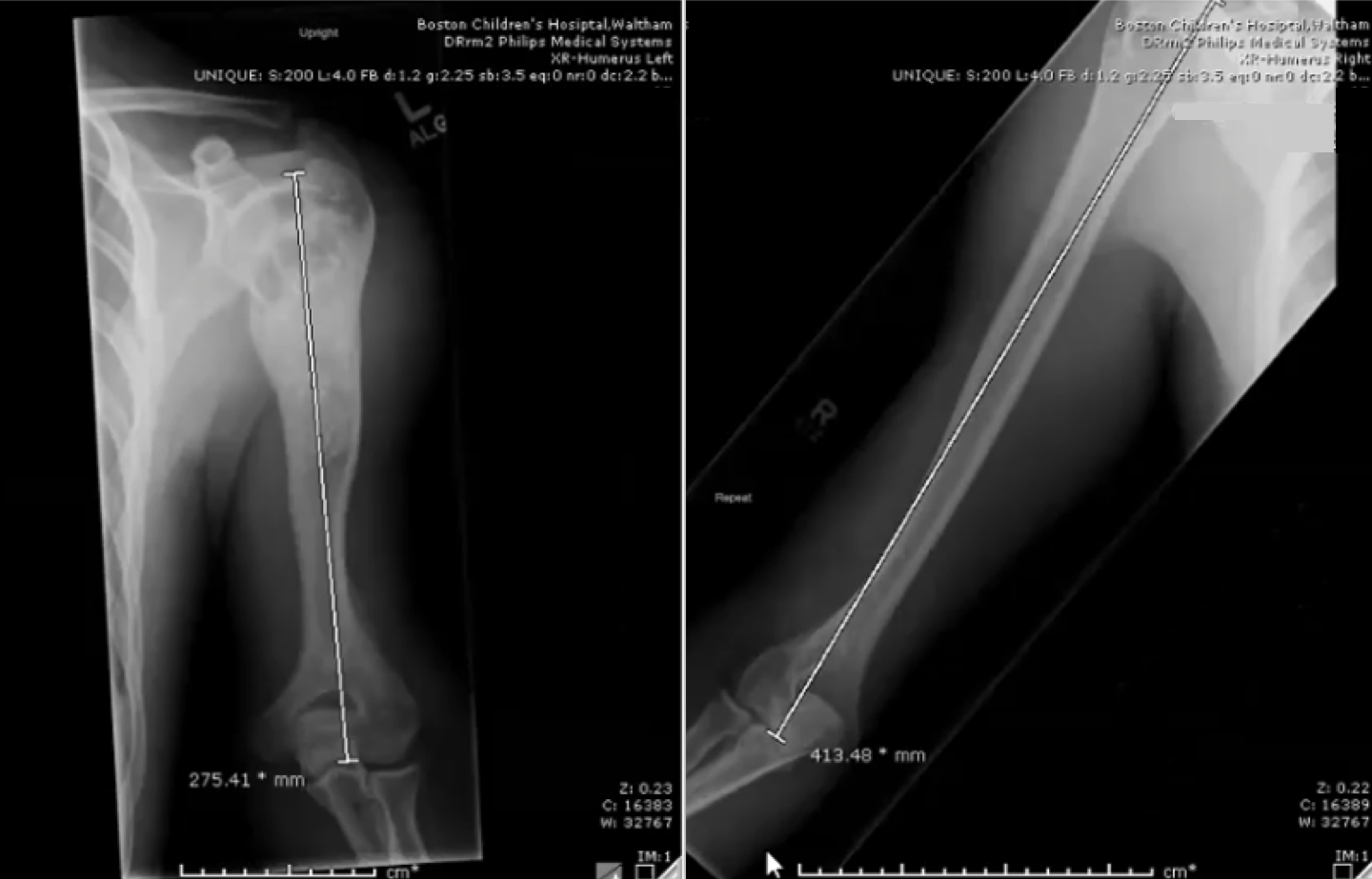 In February 2019 an 18-year-old patient had a 138-millimeter length difference between his left (left) and right (right) arms.