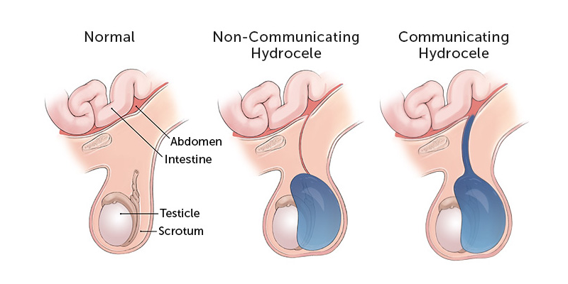 Here is an image of a normal scrotum, one with a non-communicating hydrocele, and one with a communicating hydrocele.