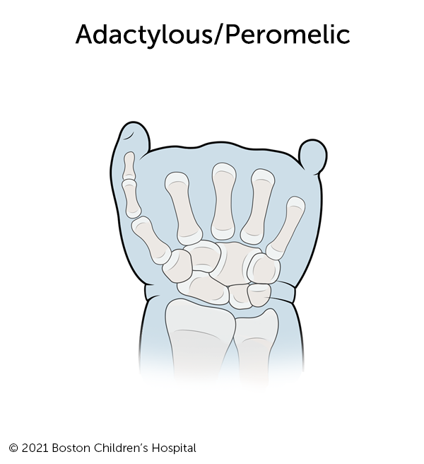 Image of adactylous/peromelic symbrachydactyly