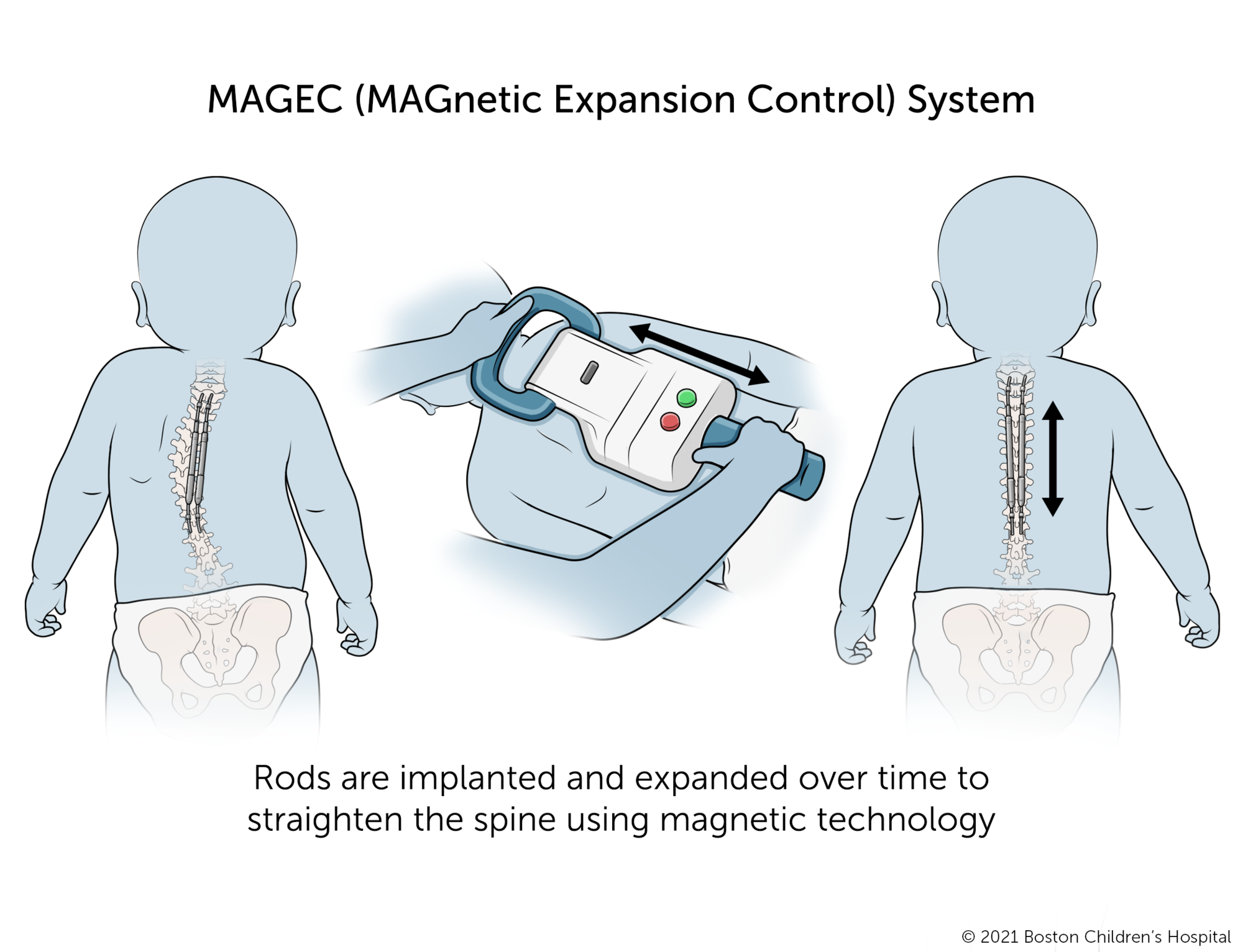 The MAGEC (Magnetic Expansion Control System). Implanted rods are slowly expanded with magnetic technology to straighten the spine over time. 