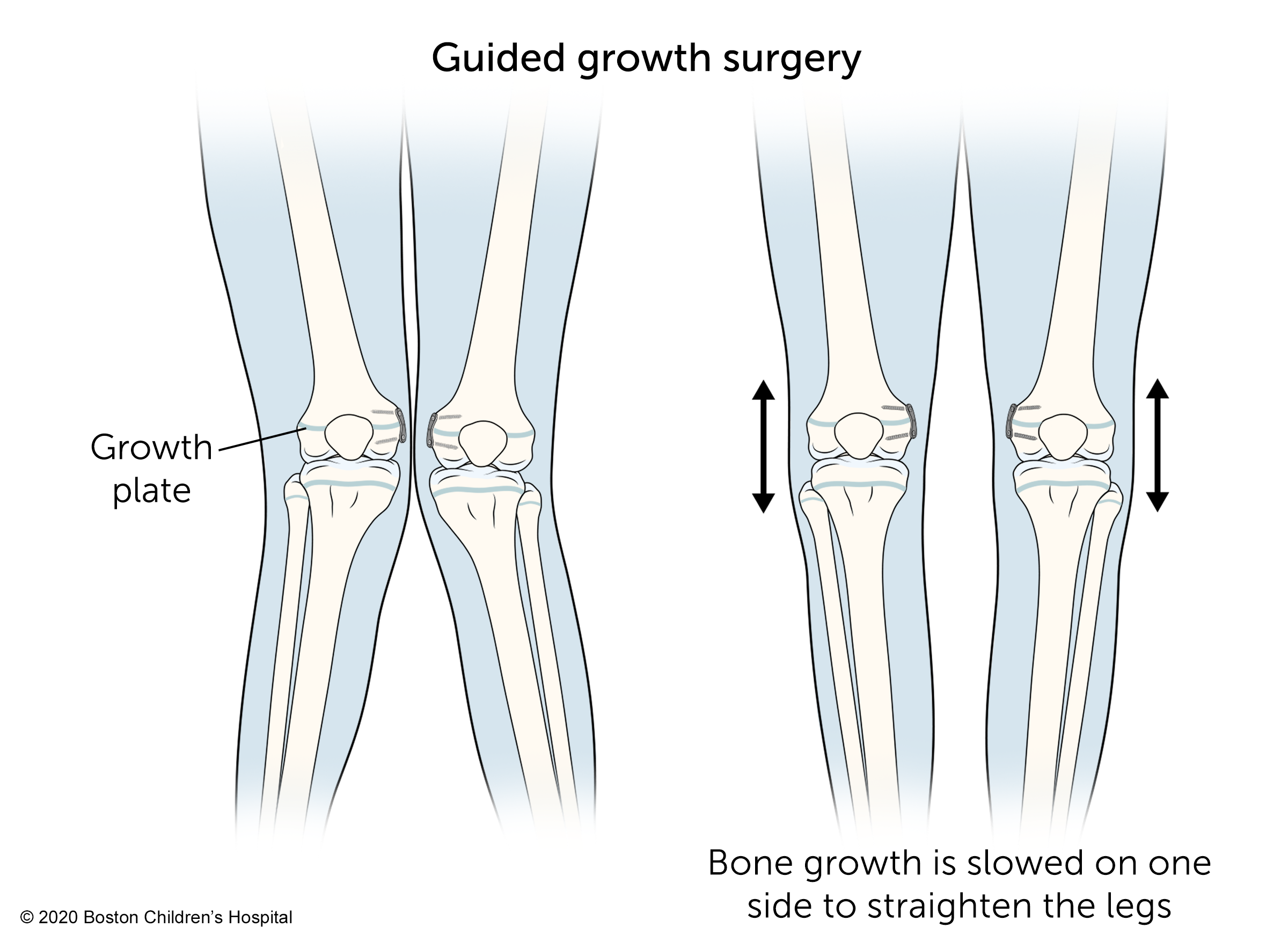 In guided growth surgery, bone growth is slowed on one side to straighten the legs.