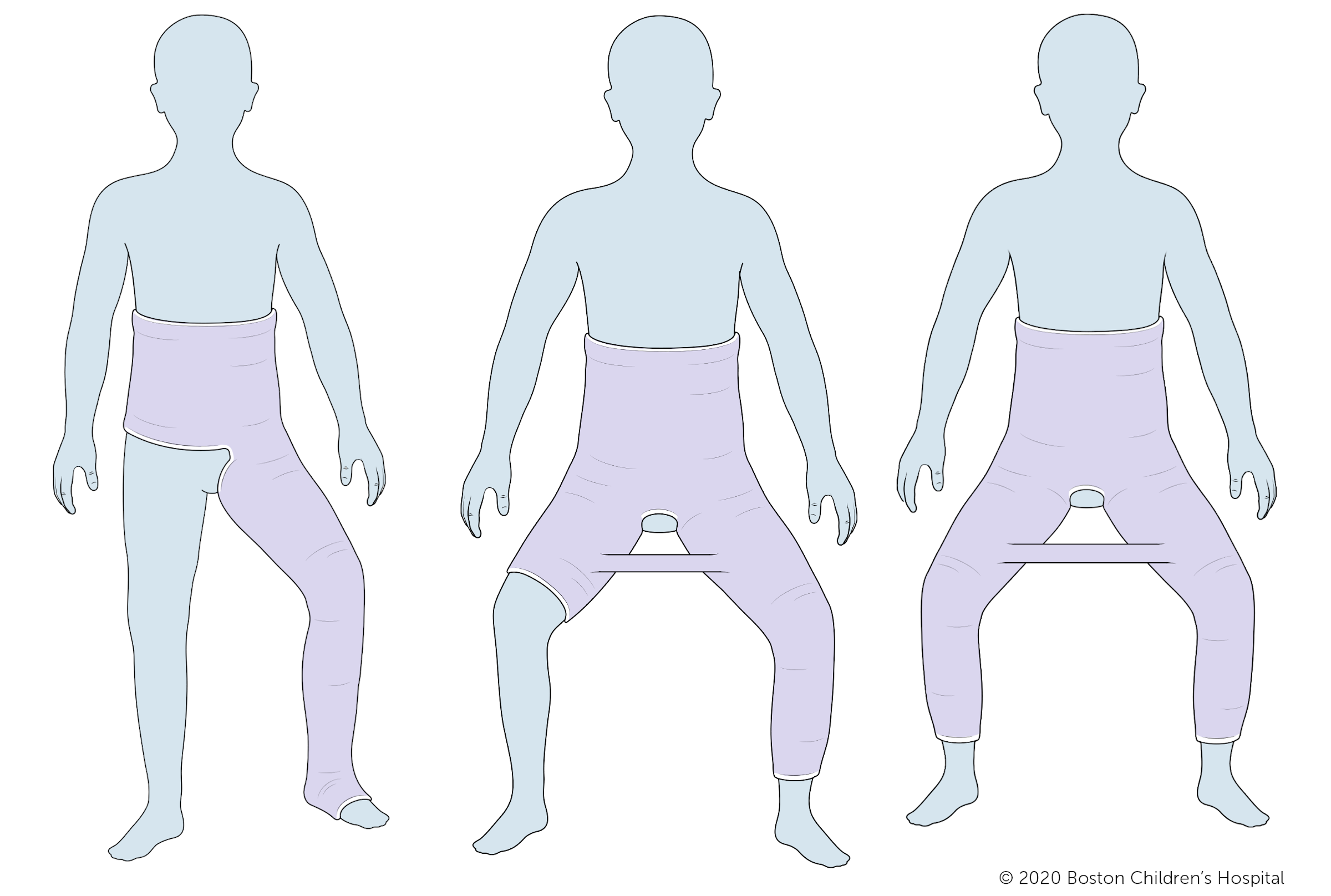 Three types of casts, from left: a unilateral hip spica cast, a one and one-half hip spica cast, and a bilateral long leg hip spica cast.