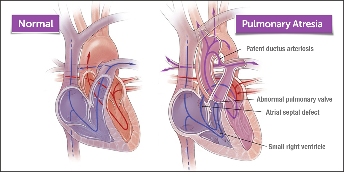 Image of a normal heart and a heart with pulmonary atresia