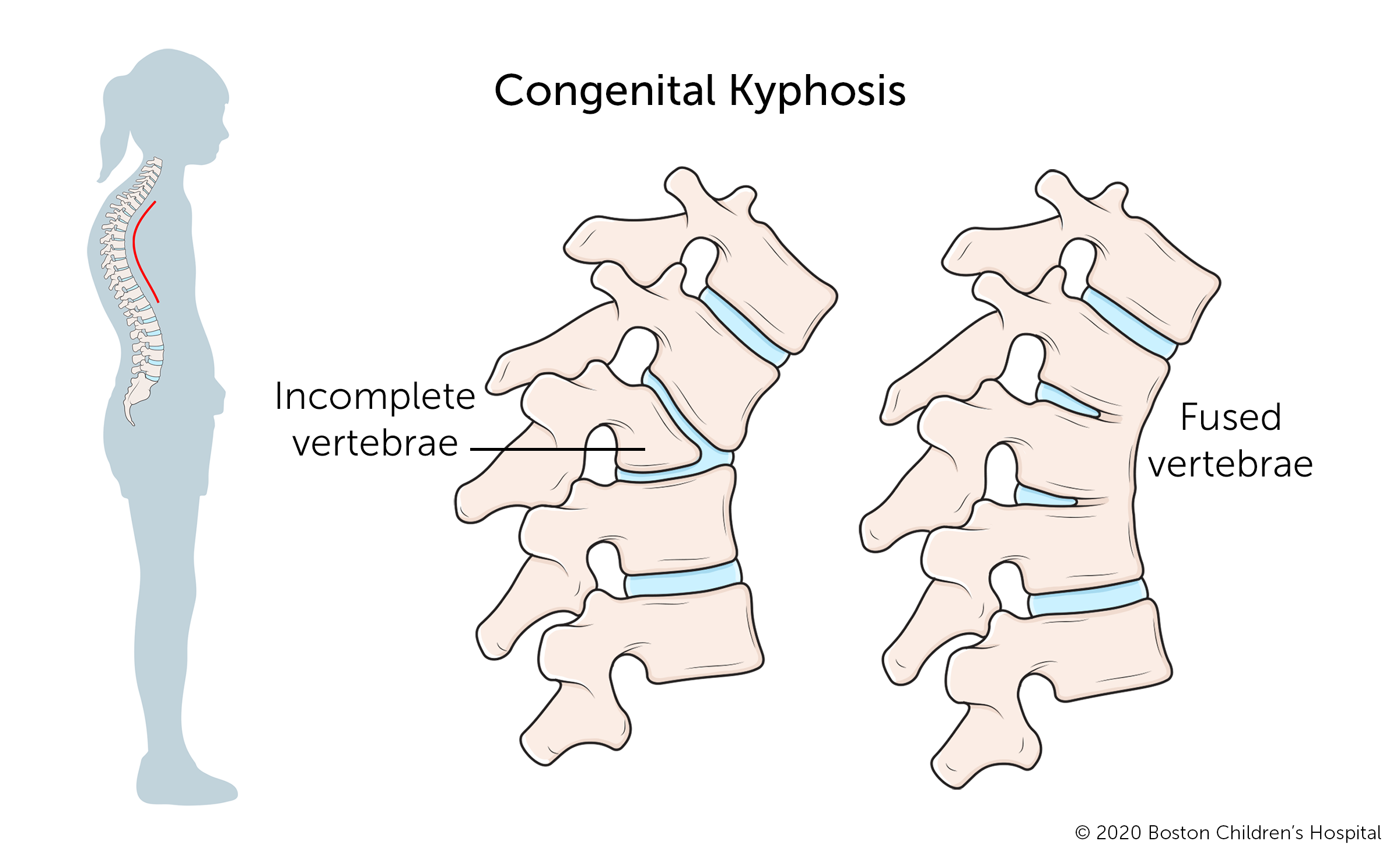 Congenital kyphosis often causes compression of the spinal cord and usually gets worse as the child grows.