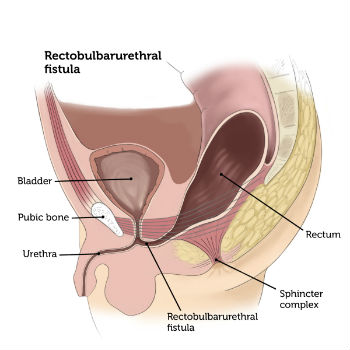 Rectobulbarurethral Fistula