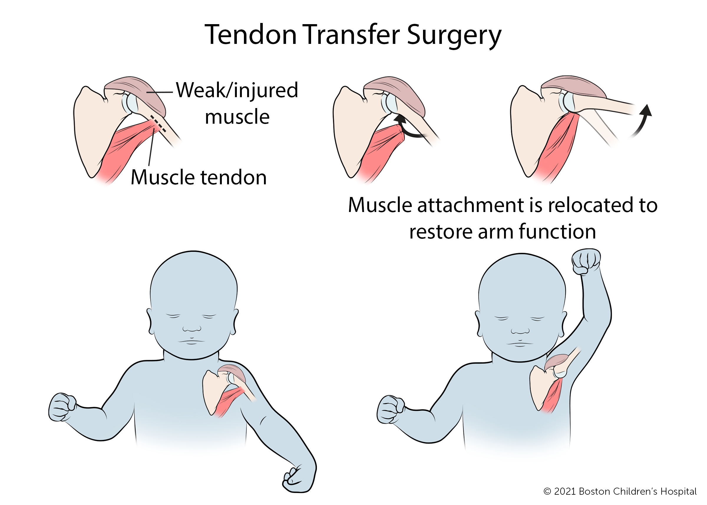 For tendon transfer surgery, the tendon of the weak or injured muscle is separated from its normal attachment point and reattached in a new location to restore arm function.