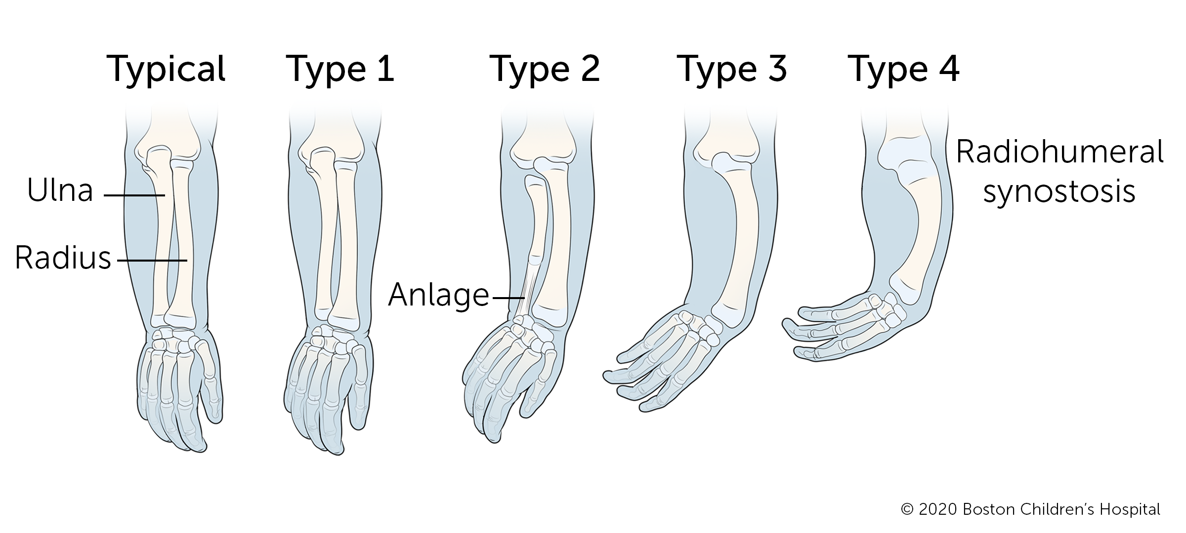 A typical arm compared to four types of ulnar longitudinal deficiency. In type 1, the ulna (the bone on the outside of the forearm) is slightly shorter than the radius (the bone on the inside of the forearm). In type 2, the ulna is significantly shorter than the radius and the hand is angled toward the outer arm. A bar of tissue called the anlage connects the end of the ulna to the wrist. In types 3 and 4, the ulna and thumb are completely missing. Other fingers can be missing or formed differently.