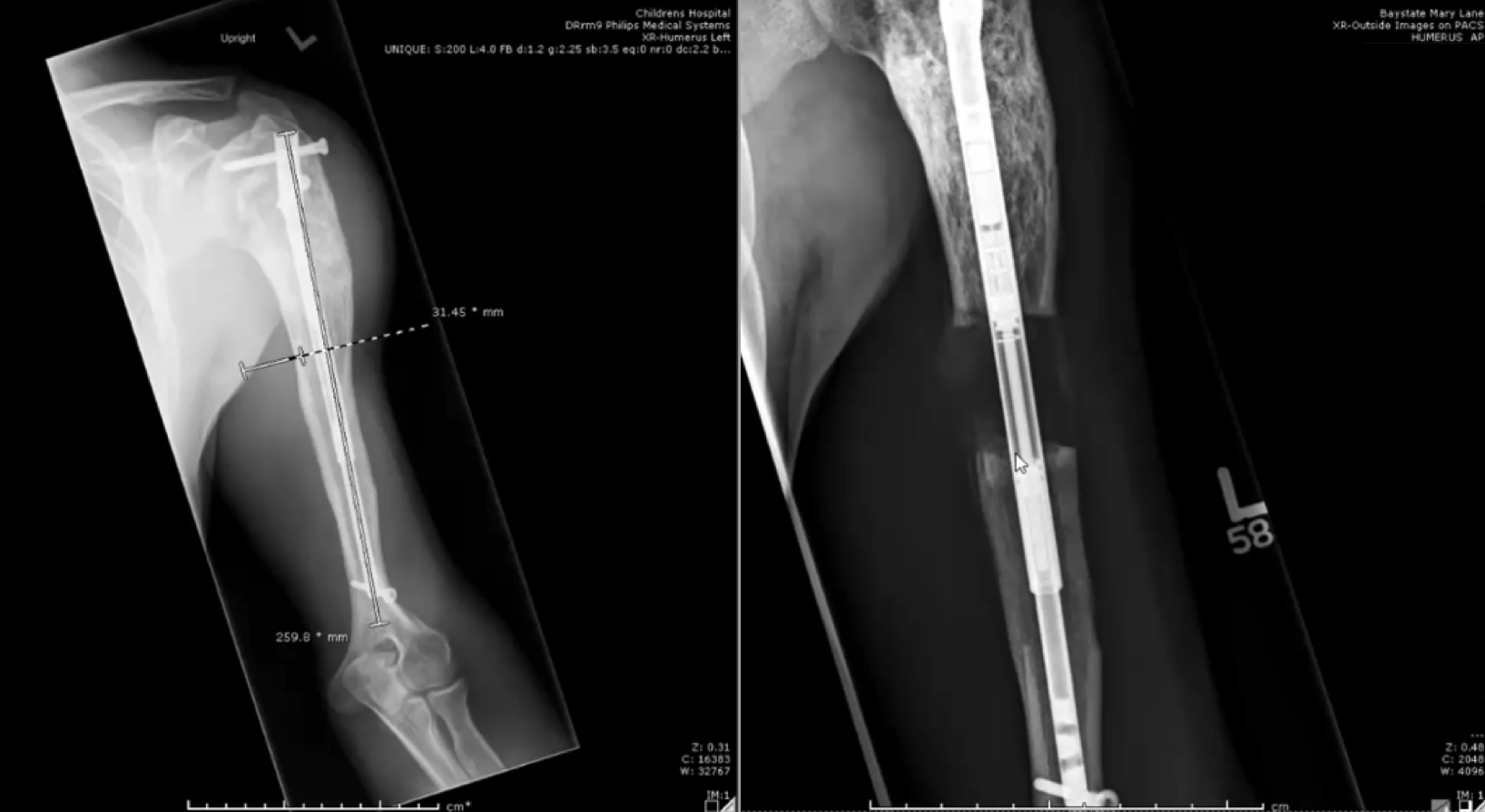 In June 2019, a PRECICE nail was inserted into the left humerus and lengthened by 5cm; in July 2020, the bone was lengthened another 5cm using a second PRECICE nail.