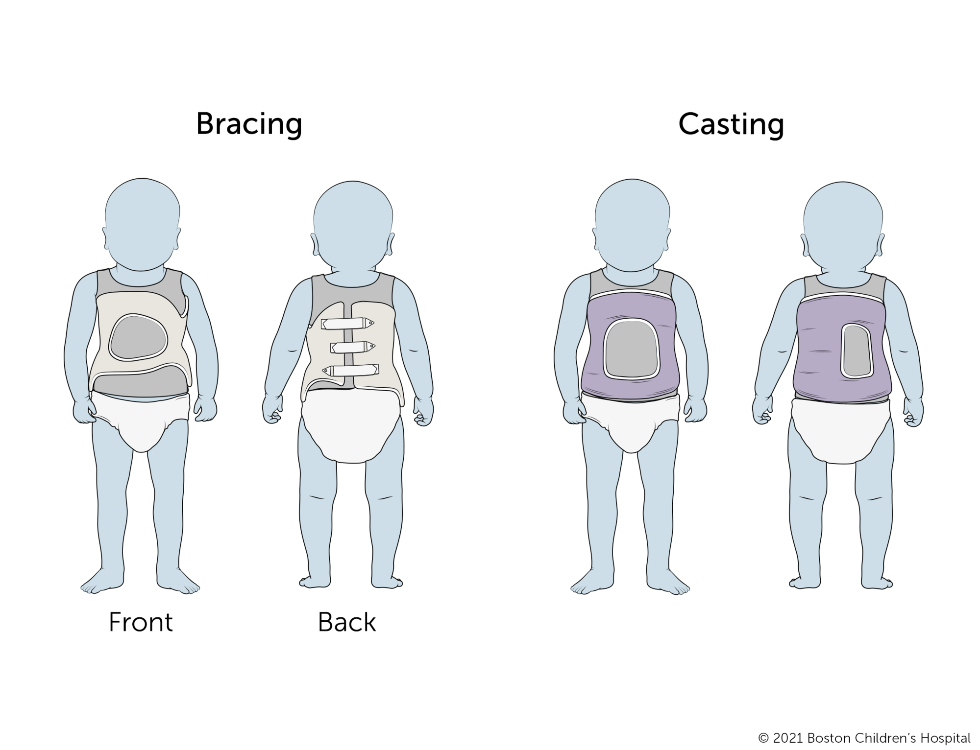 Braces for infantile scoliosis usually have a keyhole opening in the front and straps in the back. Casts for infantile scoliosis go all the way around the torso with keyhole openings in the front and back. 
