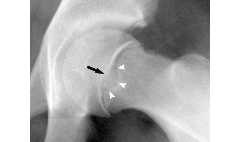 Figure 1: Peritubercle lucency on a radiograph
