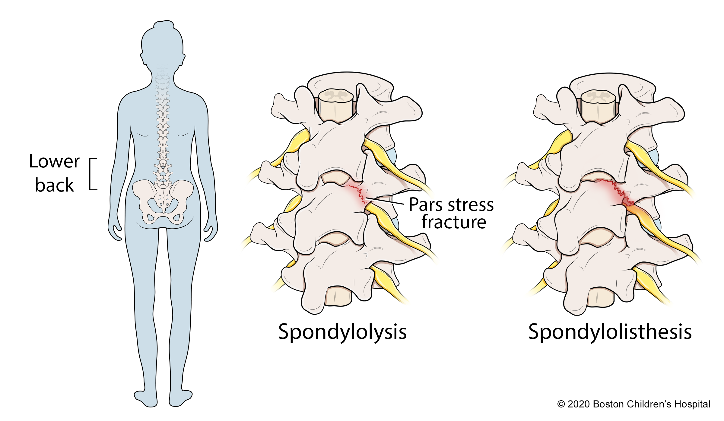 Spondylolysis can progress to spondylolisthesis, as shown in this image.